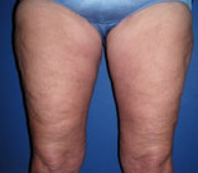 After Image: 4 Month After Medial Thigh Lift - front