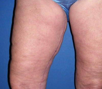 After Image: 4 Month After Medial Thigh Lift - front