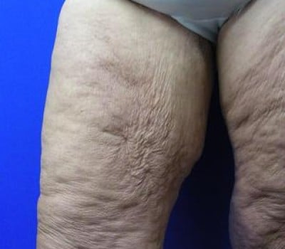 Before Image: 4 Month After Medial Thigh Lift - front