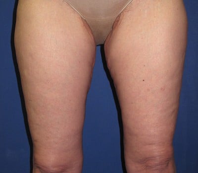 After Image: Lift Entire Skin Down To Knee - front