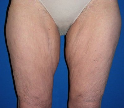 Before Image: Lift Entire Skin Down To Knee - front