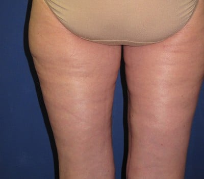 After Image: Lift Entire Skin Down To Knee - front