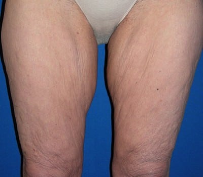 Before Image: Lift Entire Skin Down To Knee - front