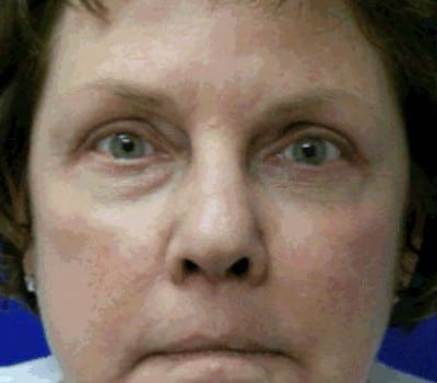 After Image: Bilateral Upper & Lower Eyelid Lifts - front