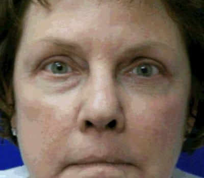 Bilateral Upper & Lower Eyelid Lifts