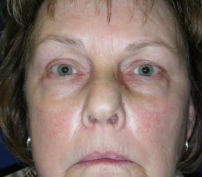 Before Image: Bilateral Upper & Lower Eyelid Lifts - front