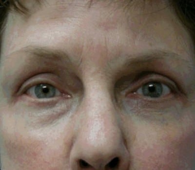 After Image: Bilateral Upper & Lower Eyelid Lifts - front