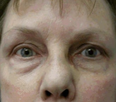 Before Image: Bilateral Upper & Lower Eyelid Lifts - front