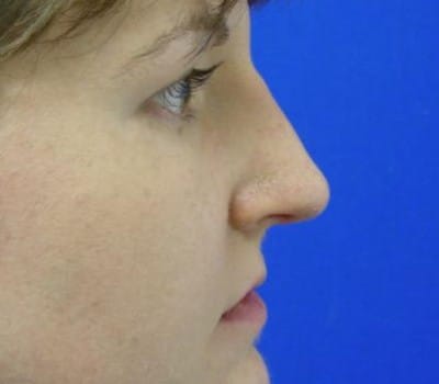 After Image: Reduced Dorsal Hump - other