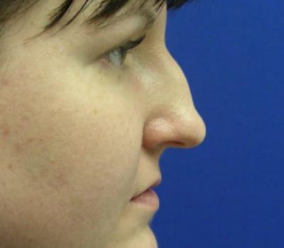 Before Image: Reduced Dorsal Hump - other