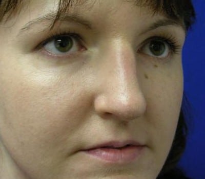 After Image: Reduced Dorsal Hump - other