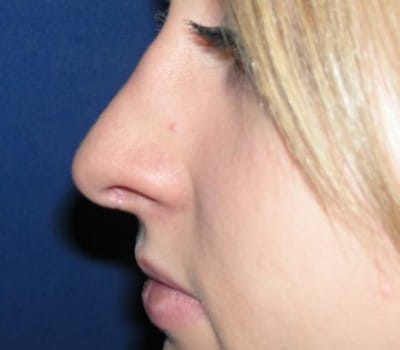 After Image: 4 Months Post-Op Open Rhinoplasty - other