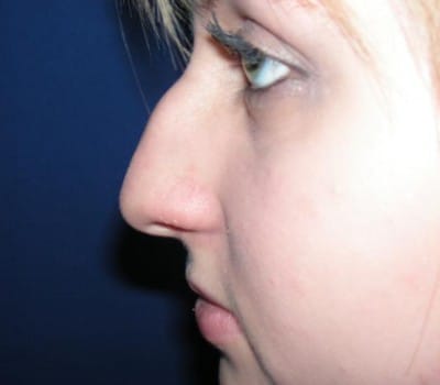 Before Image: 4 Months Post-Op Open Rhinoplasty - other
