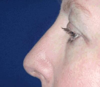 After Image: Dorsal Hump Reduction & Tip Work - other