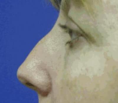 Before Image: Dorsal Hump Reduction & Tip Work - other