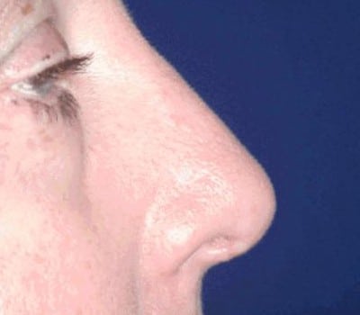After Image: Dorsal Hump Reduction & Tip Work - other