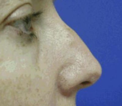 Before Image: Dorsal Hump Reduction & Tip Work - other