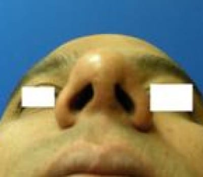 After Image: Simultaneous Nostril Narrowing - other