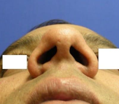 Before Image: Simultaneous Nostril Narrowing - other