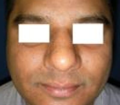 After Image: Simultaneous Nostril Narrowing - front
