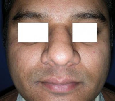 Before Image: Simultaneous Nostril Narrowing - front