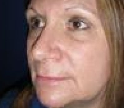 After Image: Open Rhinoplasty - other