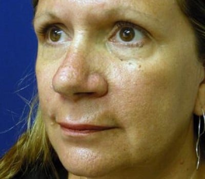 Before Image: Open Rhinoplasty - other