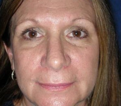 After Image: Open Rhinoplasty - front