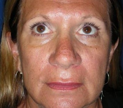 Before Image: Open Rhinoplasty - front