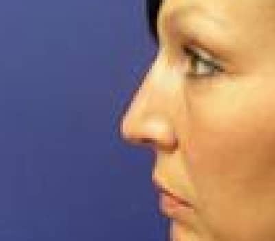 After Image: Reduced Hump & Elevated Tip - other