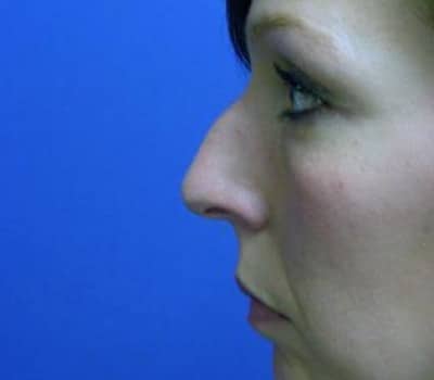 Before Image: Reduced Hump & Elevated Tip - other