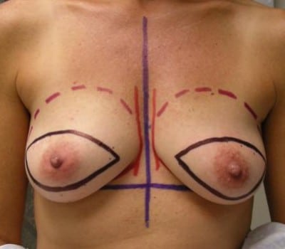Before Image: Bilateral Mastectomy - front