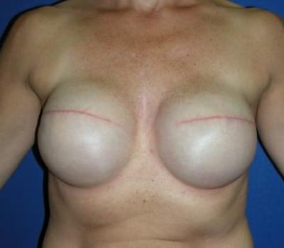 After Image: Bilateral Mastectomy - front