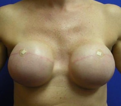 Before Image: Bilateral Mastectomy - front