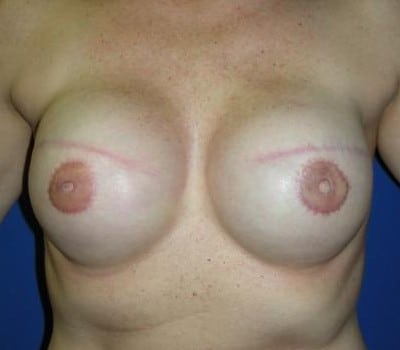 After Image: Bilateral Mastectomy - front