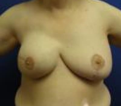 After Image: Right Mastectomy For Breast Cancer - front