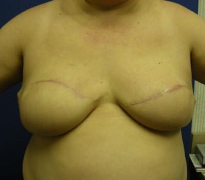 After Image: silicone gel implants (700cc) - front