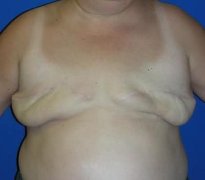 Before Image: silicone gel implants (700cc) - front