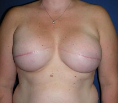 After Image: Bilateral Mastectomies - front