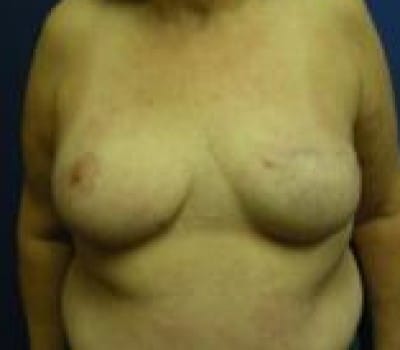 After Image: Left Mastectomy For Breast Cancer - front