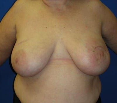 Before Image: Left Mastectomy For Breast Cancer - front