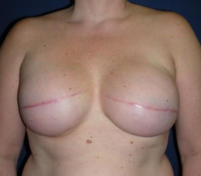 After Image: Right Breast Cancer - front