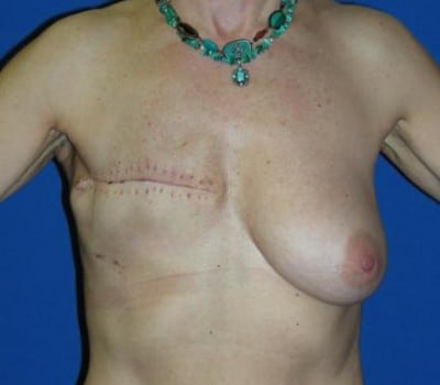 Before Image: 325cc Gel Implant - front