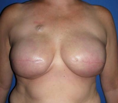 After Image: 550 cc Silicone Gel Implants Bilaterally - front