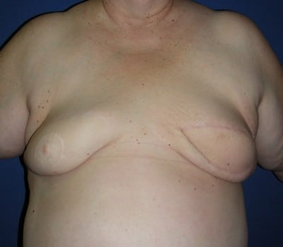After Image: Autologous Left Breast Reconstruction - front
