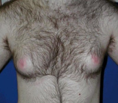 Before Image: 17 Years Old 3 Months Post-Op - front