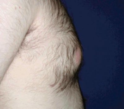 After Image: 17 Years Old 3 Months Post-Op - right-side