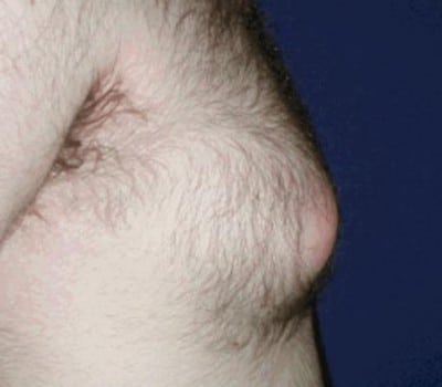 Before Image: 17 Years Old 3 Months Post-Op - right-side