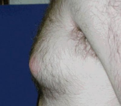 Before Image: 17 Years Old 3 Months Post-Op - left-side