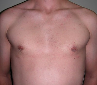 After Image: 23 Years Old 3 Months Post-Op - front